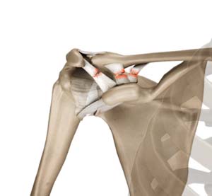 Acromioclavicular Joint (AC Joint) Dislocation