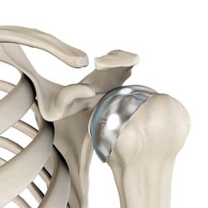 Partial Shoulder Replacement